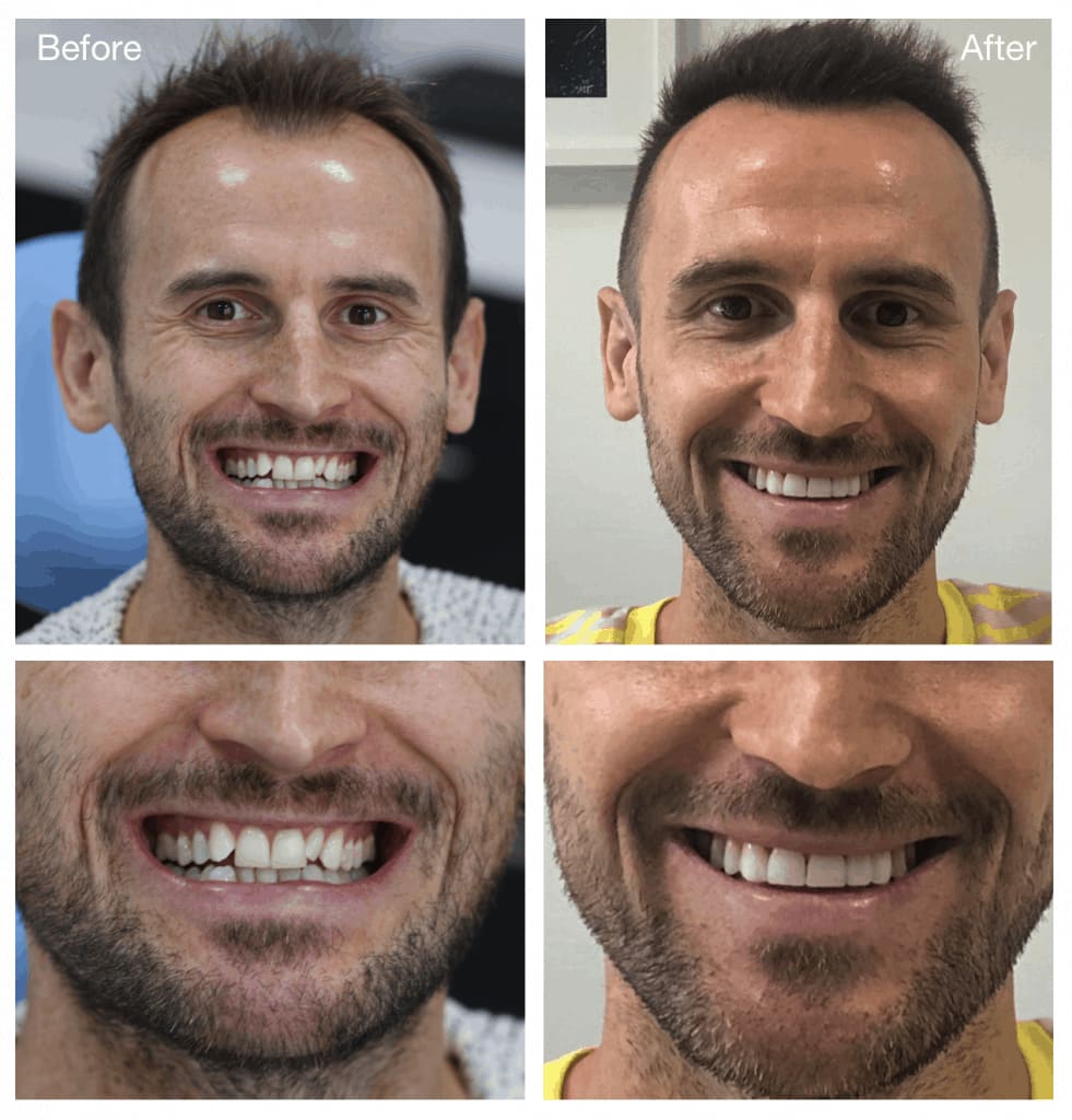 Duncan-before-and-after-Invisalign