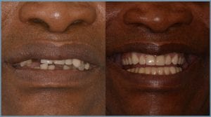 Leonard Before and After Dental Implants